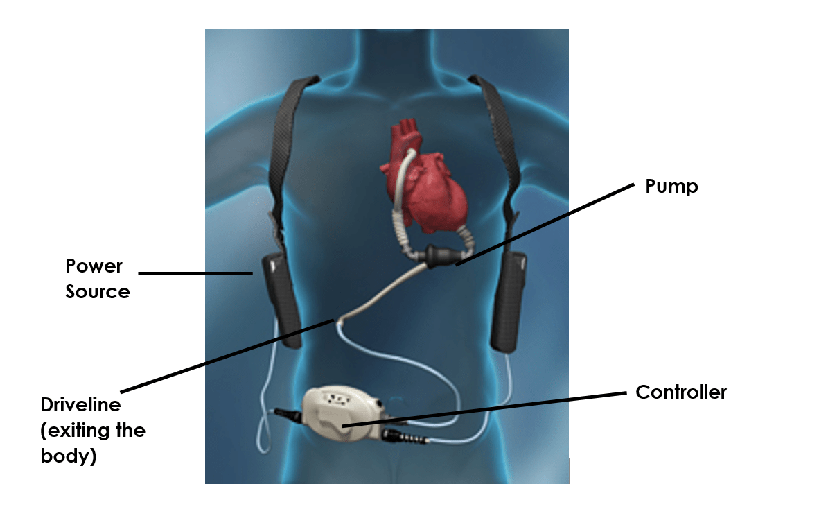 LVAD Figure