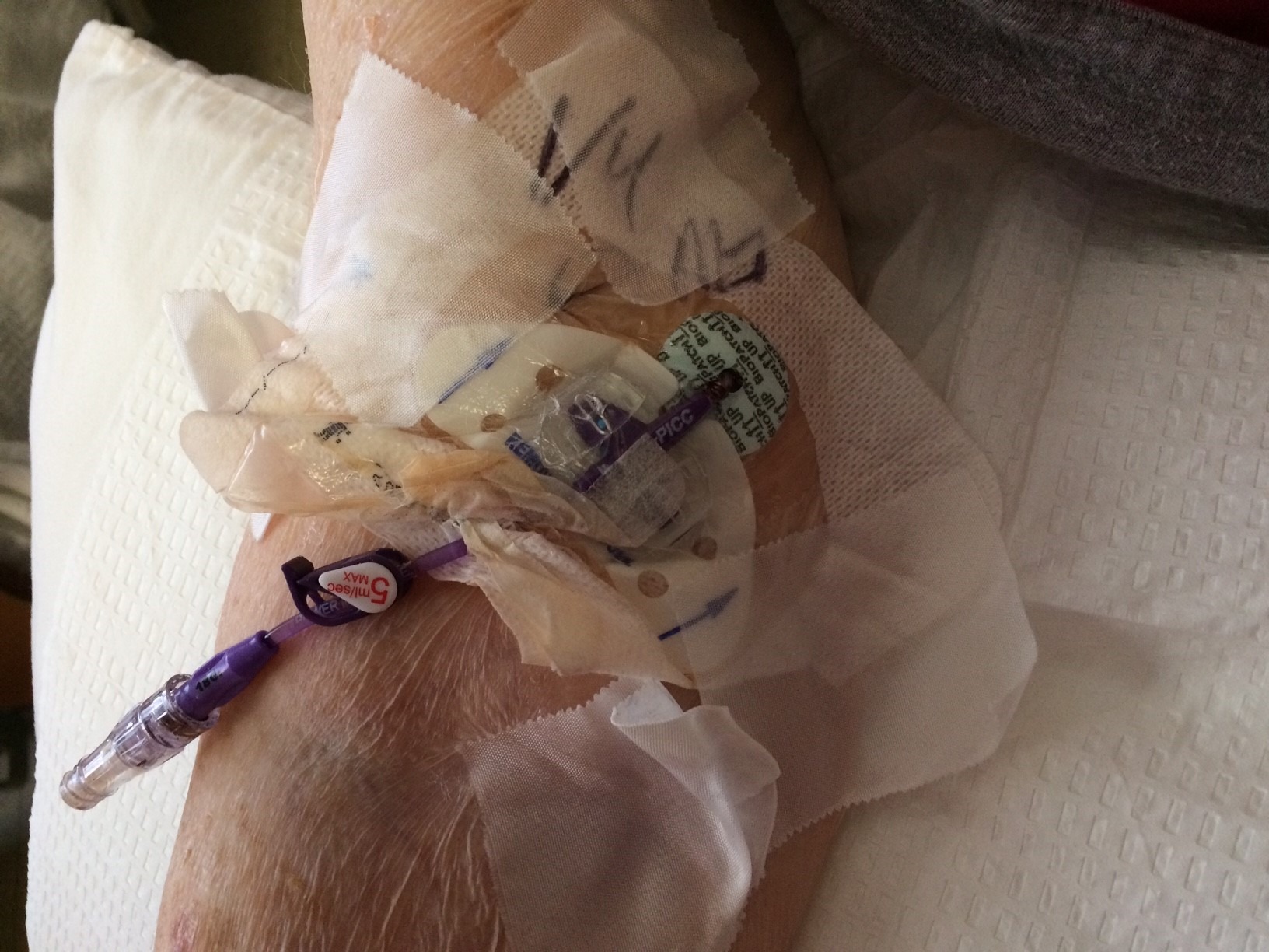 Gnarly Point Prevalence Image Vascular access dressing disruption